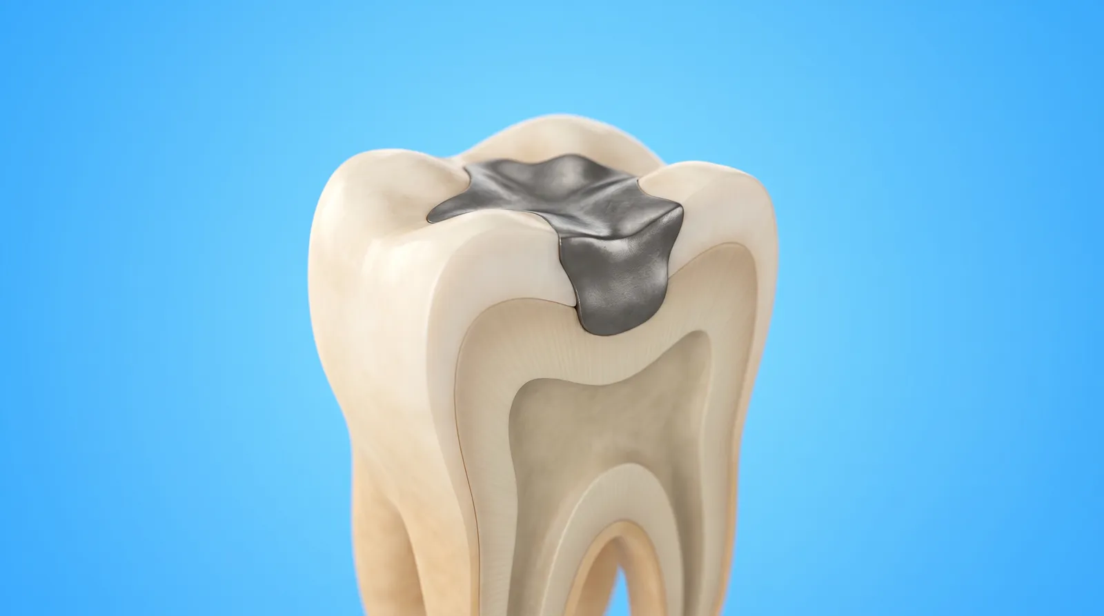 A cut-through molar with a solid dark metal block sitting loose inside the cavity
