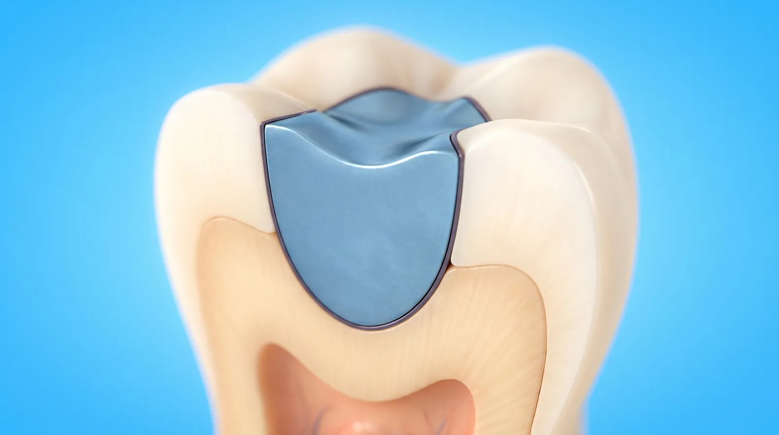 A cut-through molar showing a fine dark line all the way around the edge of a metal filling