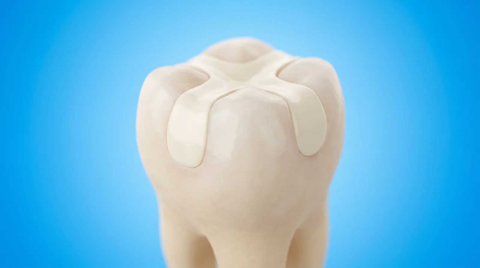 A molar with a tooth coloured filling that is almost invisible against the enamel