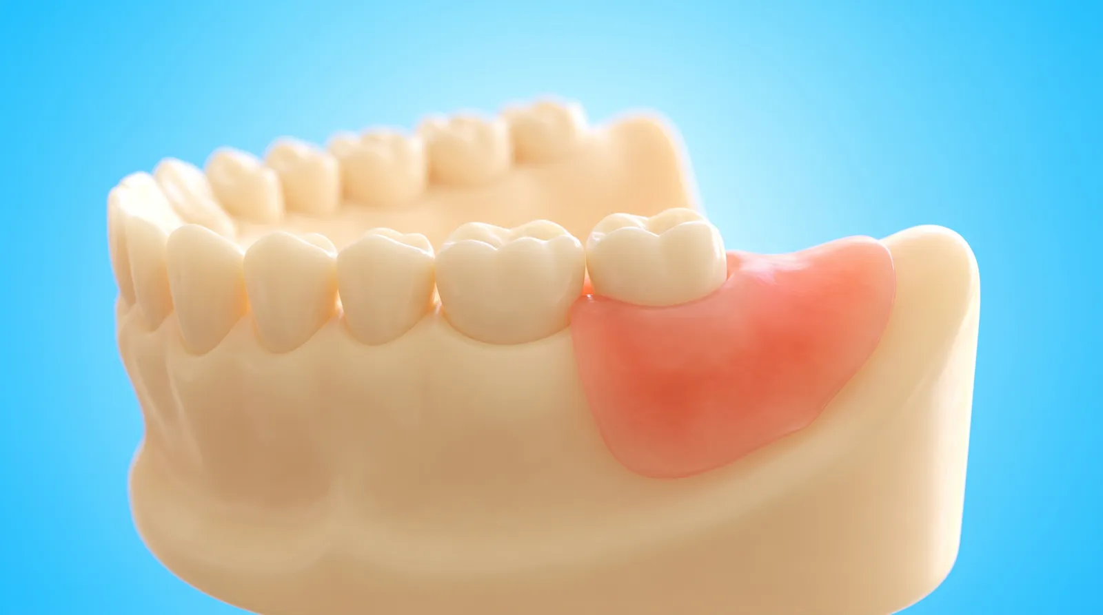 A lower jaw model seen from behind, the back molar half covered by a flap of gum