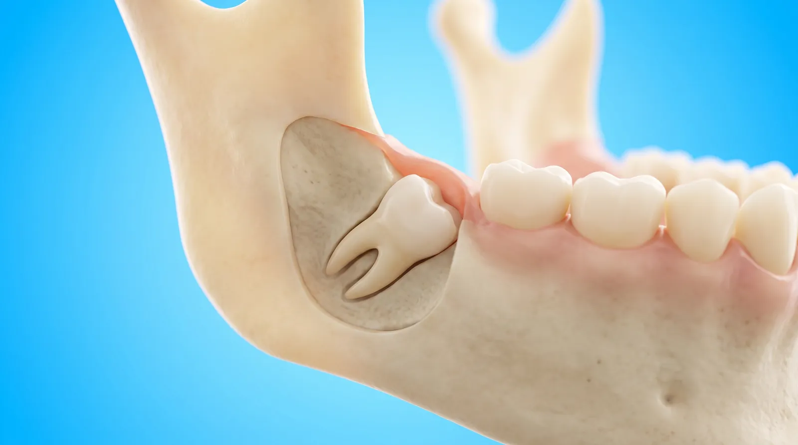 A cut-through jaw showing a wisdom tooth lying on its side under the gum