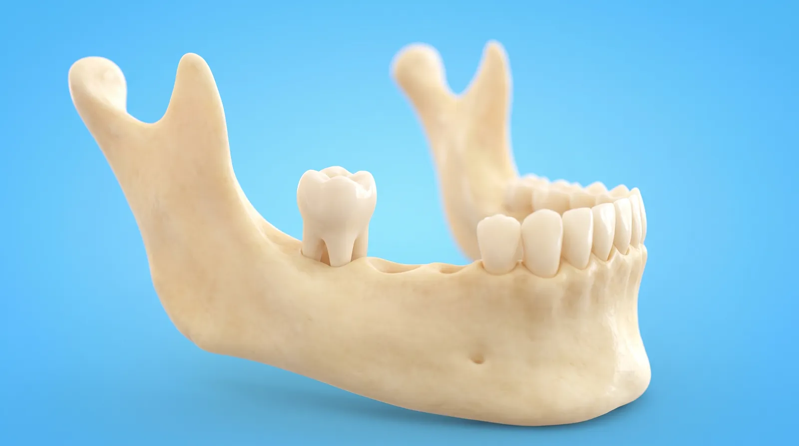 A lower jaw model with a fully upright wisdom tooth standing clear with space around it